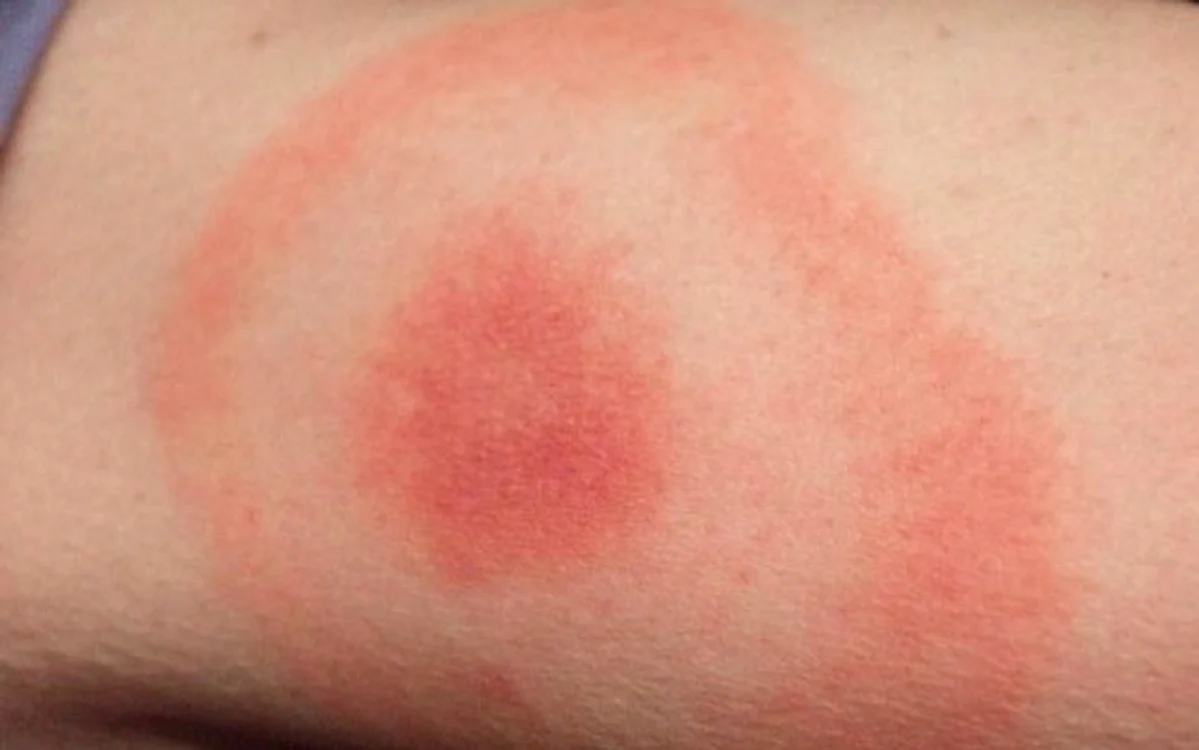 După muşcătura de căpuşă, poţi să nu prezinţi niciun simptom sau se poate întâmpla să suferi o reacţie alergică.