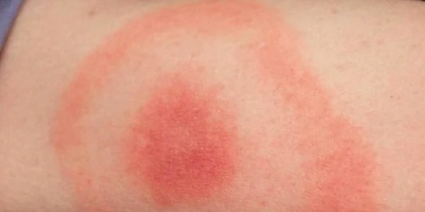Dacă remarcaţi o astfel de reacţie pe piele, mergeţi urgent la medic. V-a muşcat o căpuşă!