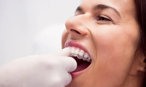 Aparat dentar Spark cum arata de fapt tratamentul zi de zi jpg