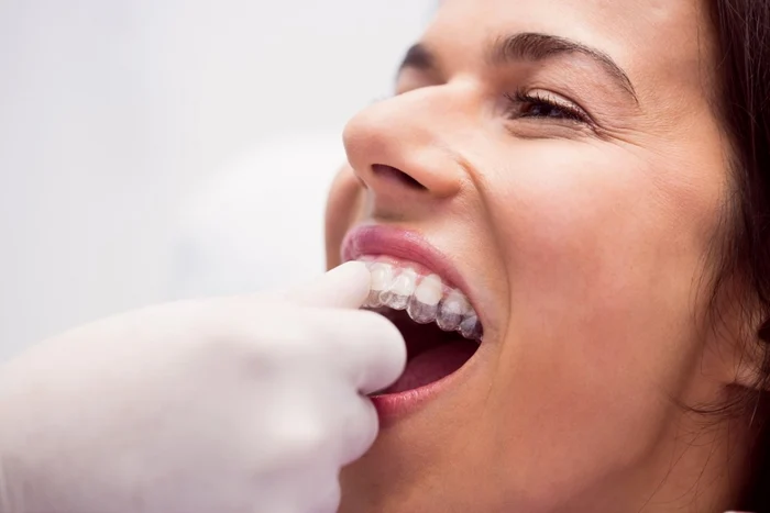 Aparat dentar Spark cum arata de fapt tratamentul zi de zi jpg