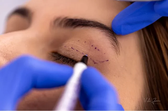 Desenul pre operator in blefaroplastie Sursa foto Dr. Alina Mȋtcan