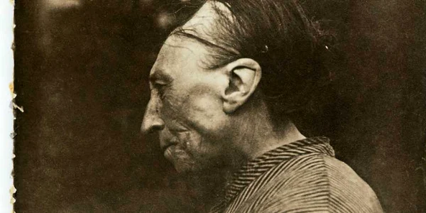 Deformare artificiala a craniului 