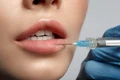 marire buze cu acid hialuronic skin medspa jpeg