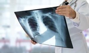 cancer plamani jpg