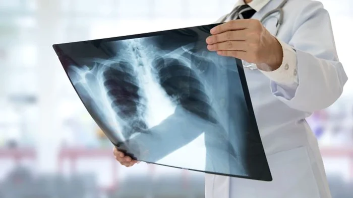 Cancerul la plămăni, depistat în stadii avansate FOTO: Arhivă