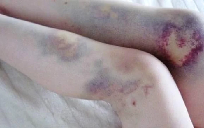 
    Vânătăile femeii ascundeau o boală gravăfoto: lethow.com  