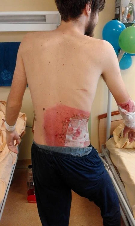 Arsurile lui Alex Plîngu încep să se vindece