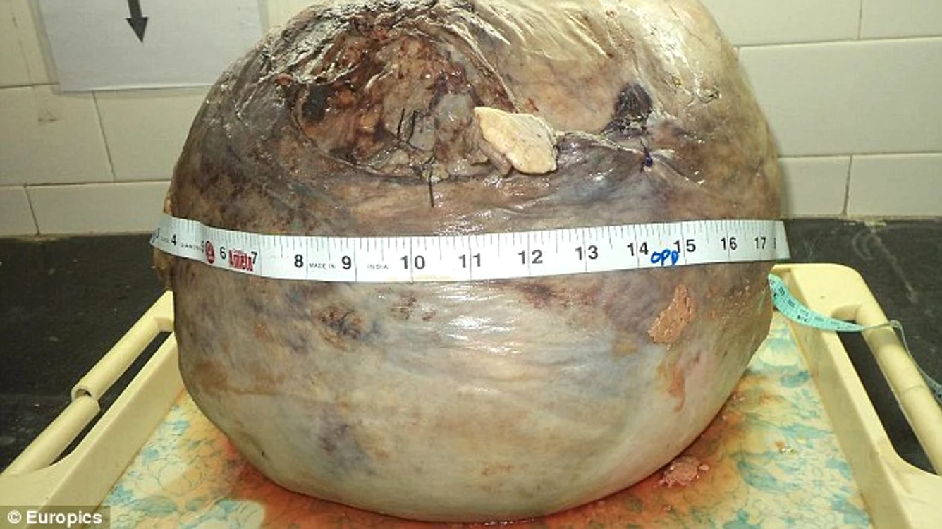 
    Tumora din uterul femeii avea 30 de kilograme si 53 de centimetri în diametru  