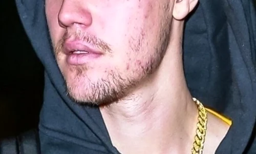 Justin Bieber a explicat pe Instagram motivul pentru care în ultima perioadă a suferit de acnee, oboseală și o stare generală de rău jpeg