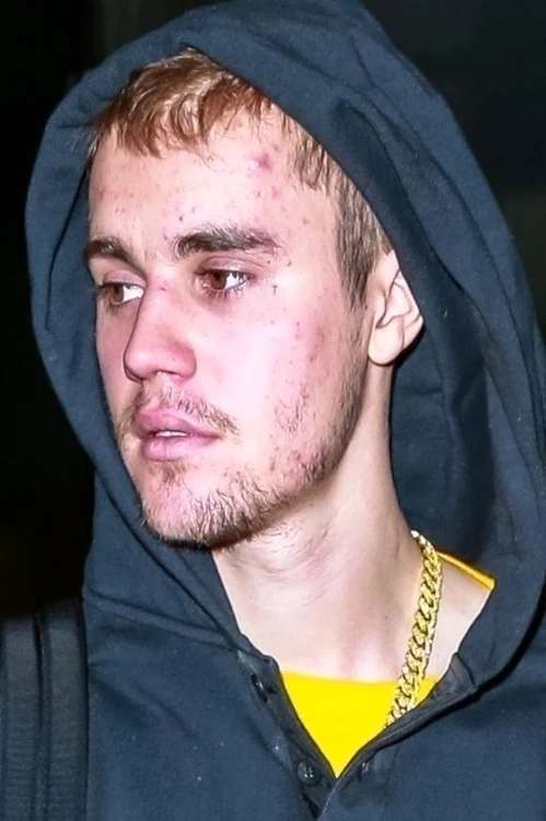 Justin Bieber a explicat pe Instagram motivul pentru care în ultima perioadă a suferit de acnee, oboseală și o stare generală de rău