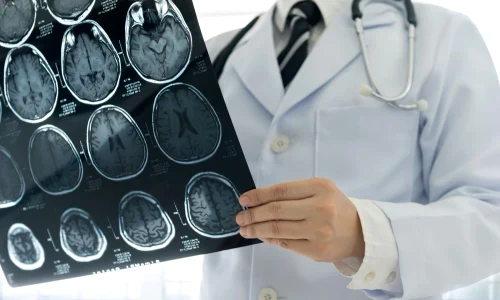 sclaroza multipla jpg