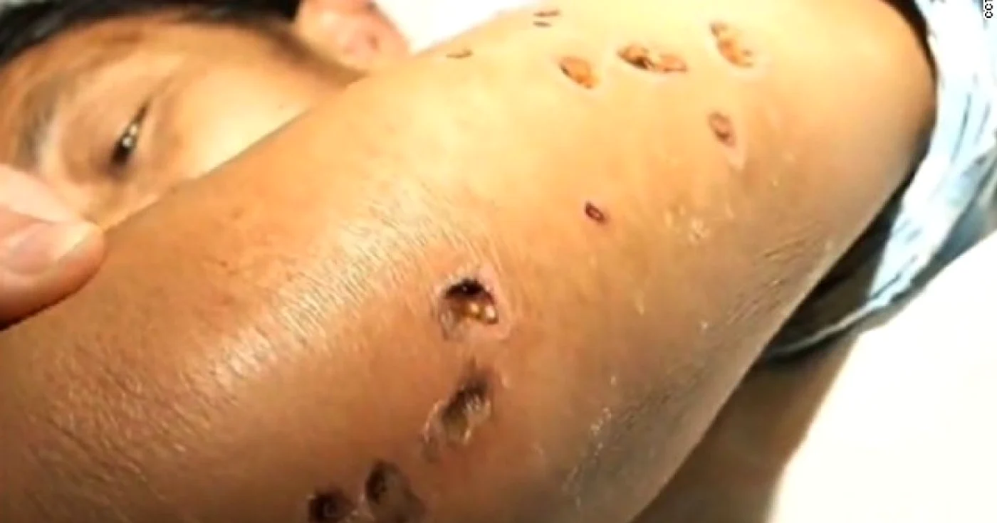 Viespile au o lungime cuprinsă între 3,5 şi 3,9 centimetri, iar rănile pe care le produc prin înţepare sunt asemănătoare cu plăgile prin împuşcare. FOTO via CNN