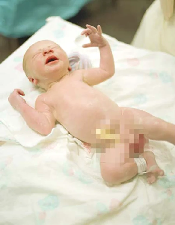 Băieţelul a început un program de lungă durată de refacere a penisului