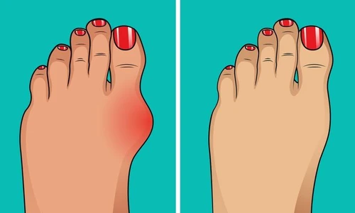 Scapă de monturi fără operaţie! Cinci remedii eficiente jpeg