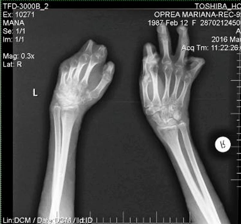 Marianei i-au fost amputate toate degetele de la mână stângă, și parțial cele de la mâna dreaptă