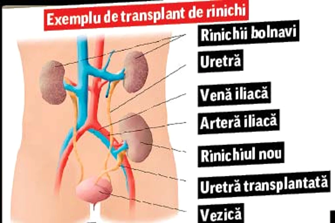 Victor Socaciu  a fost operat acum patru ani
