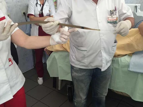 Operaţie în premieră pentru o copilă la Clinica de Gastroenteroogie din Iaşi