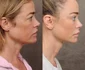 Denise Richards lifting, Foto Instagram