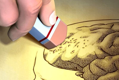 diagnosticat cu Alzheimer Foto   Shutterstock png