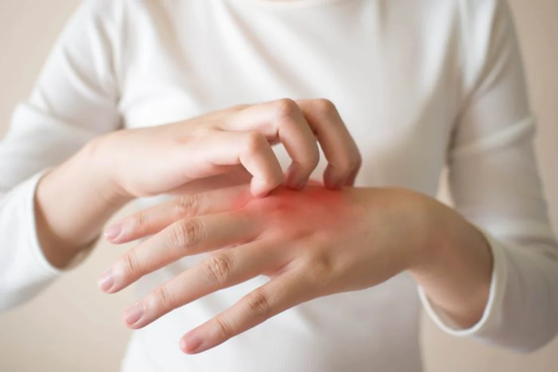 1 eczema jpg jpeg