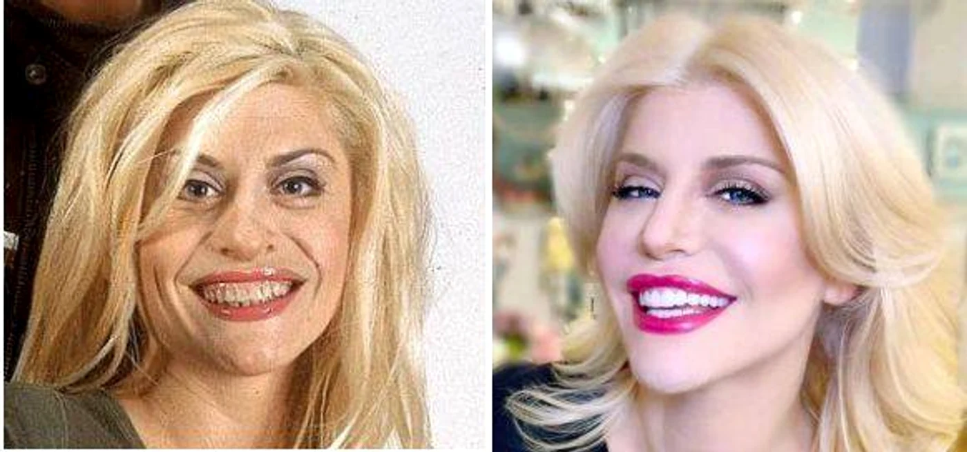 
    În 2003, pe când prezenta emisiunea “Pop Stars” la PRO TV, Loredana Groza avea serioase probleme cu dinții  