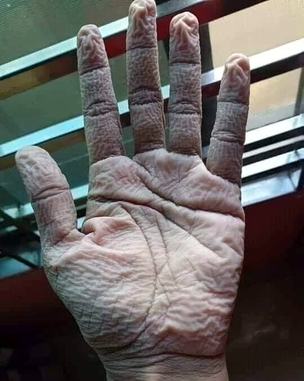 
    Așa arată mâinile unui medic de pe secția Covid-19, după zile întregi de purtat mănuși de protecțieFotografii: solidaritatea-sanitara.ro  