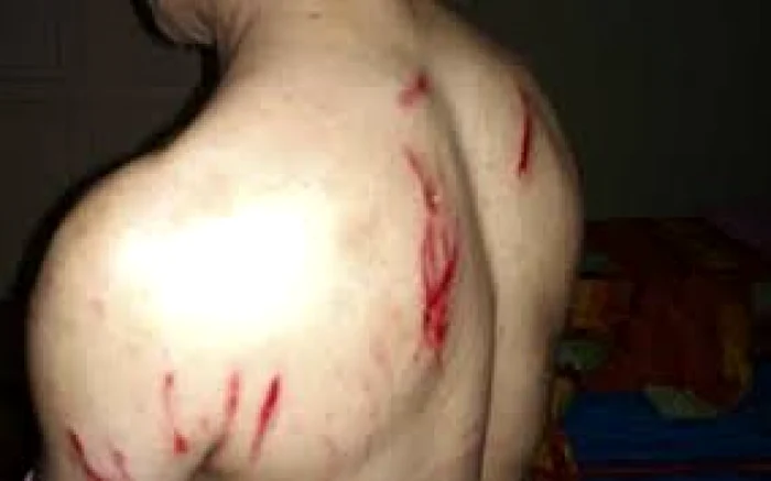 Victima a fost ajutată de salvamontiştii şi jandarmii dâmboviţeni care i-au acordat primul ajutor şi l-au coborât până la Sanatoriul Moroieni, de unde a fost preluat de o ambulanţă şi dus la Spitalul din Pucioasa
