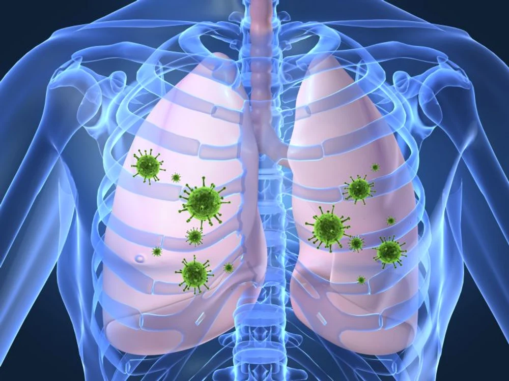 Pneumonia este cauzată de bacteria numită Steptococcus pneumoniaeclickpentrufemei.ro.