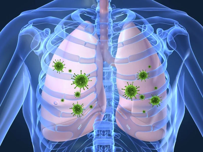 Pneumonia este cauzată de bacteria numită Steptococcus pneumoniaeclickpentrufemei.ro.