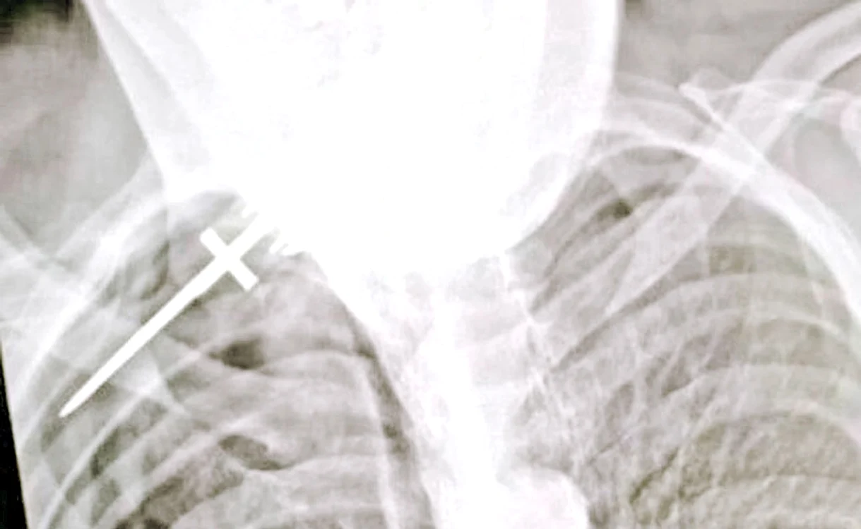 Potrivit radiografiei, rana i-a pus bărbatului viaţa în pericol