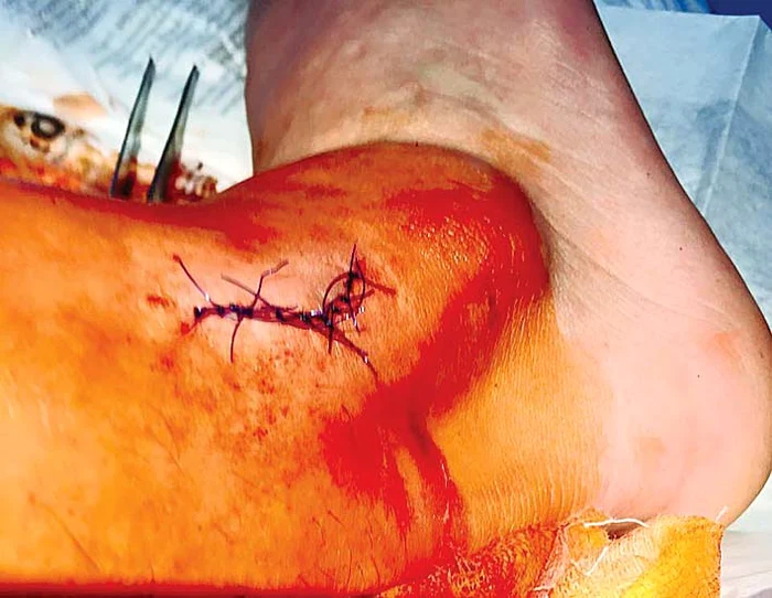 Aşa arăta glezna lui Viziru după ce medicii l-au cusut