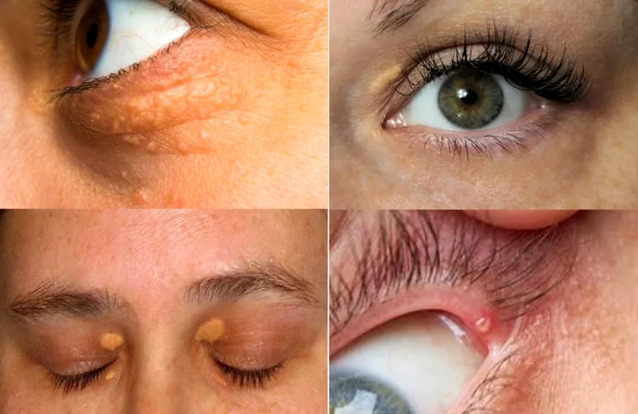 Simptomele colesterolului ridicat ce apar pe față - xantelasma Colaj Adevarul