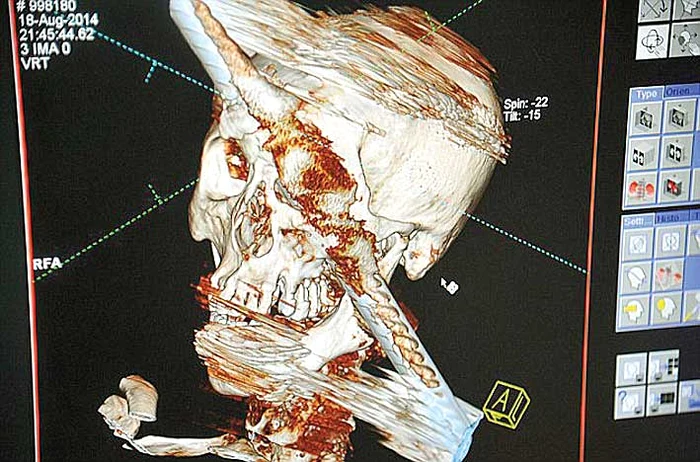 Bara de metal nu i-a produs leziuni grave