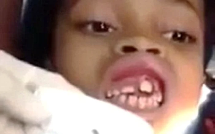 
    Ana Cardoso (10 ani) a rezistat cu stoicism cât timp dentistul i-au scos viermii din gurăcaptură: youtube.com  