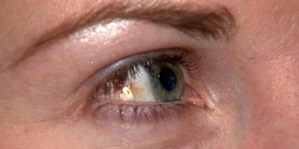 implant pe globul ocular