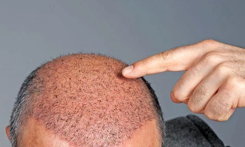 implant par dr felix 115 jpg