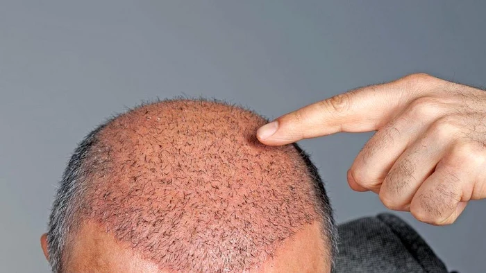 implant par dr felix 115 jpg