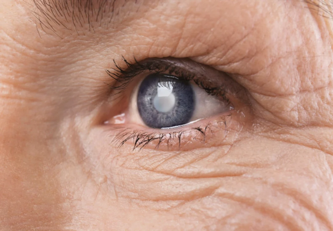 Explozie de cazuri de cataractă în 2026. 