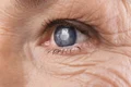 Cataracta Shutterstock 3 png