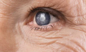 Cataracta Shutterstock 3 png