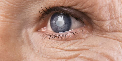 Cataracta Shutterstock 3 png
