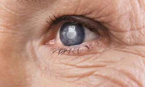 Cataracta Shutterstock 3 png