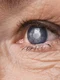 Cataracta Shutterstock 3 png