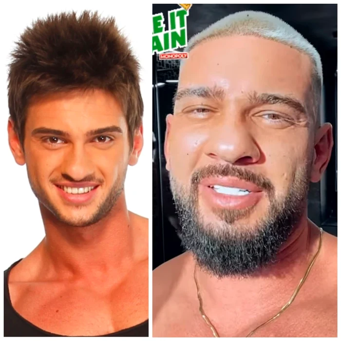 Dorian Popa a cheltuit mai bine de 50.000 de euro pe operațiile estetice