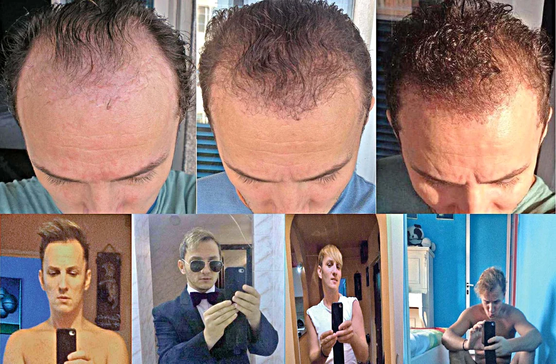 Şi-a făcut implant de păr