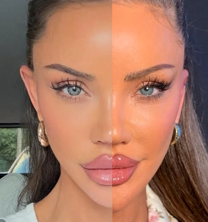 Bianca Drăgușanu a dezvăluit acum și rezultatul intervenției / sursă: Instagram