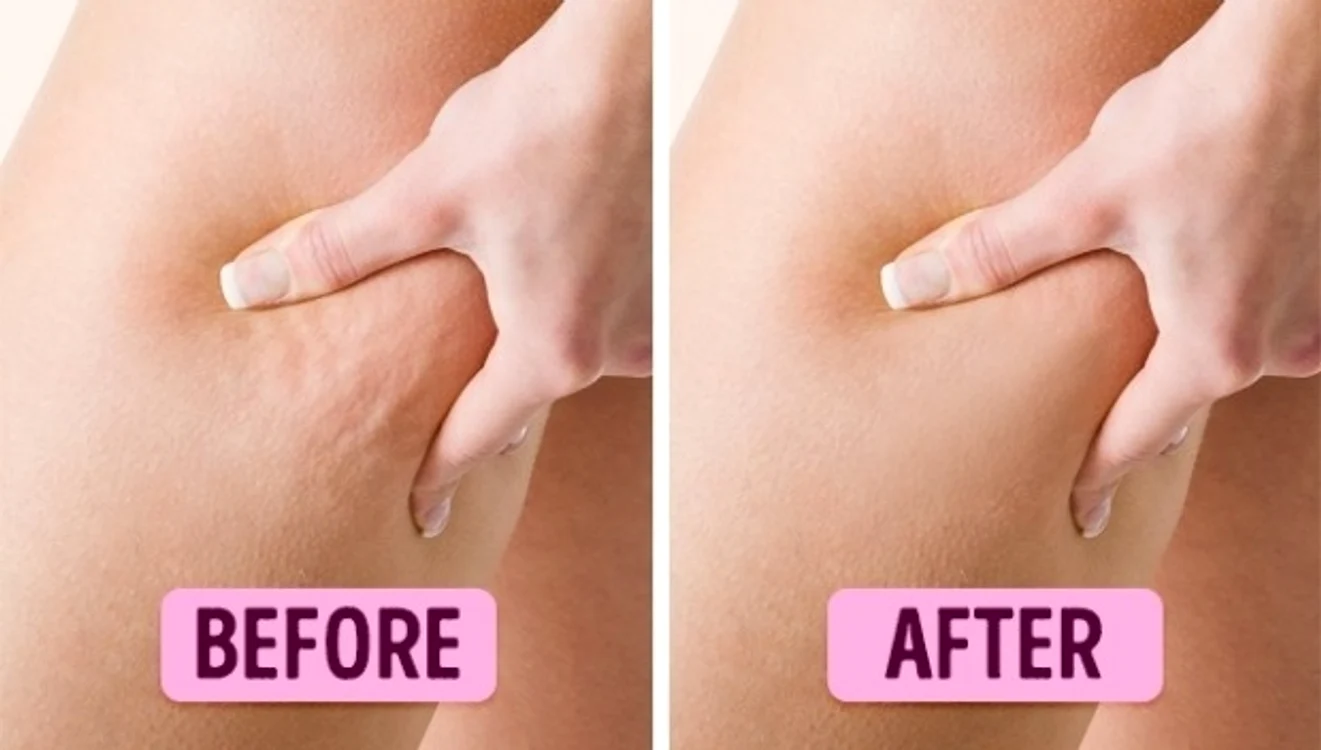 Ia ţi adio de la celulită! Ce conţine crema care îţi va face picioarele frumoase şi catifelate jpeg
