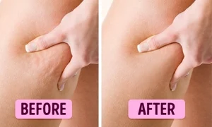 Ia ţi adio de la celulită! Ce conţine crema care îţi va face picioarele frumoase şi catifelate jpeg