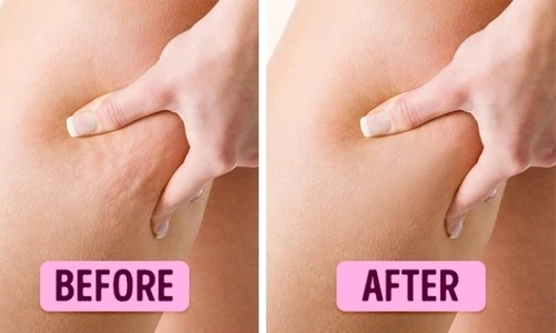 Ia ţi adio de la celulită! Ce conţine crema care îţi va face picioarele frumoase şi catifelate jpeg