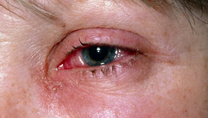 Nouă persoane au ajuns la spital cu ochii iritați de la clorul din piscină